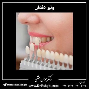 ونیر دندان