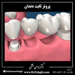 پروتز ثابت دندان