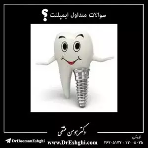 سوالات متداول ایمپلنت