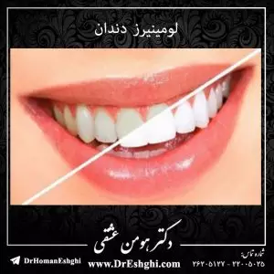 لومینیرز دندان