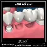 پروتز ثابت دندان
