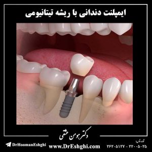 ایمپلنت دندانی با ریشه تیتانیومی