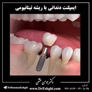 ایمپلنت دندانی با ریشه تیتانیومی