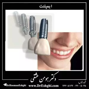 ایمپلنت چگونه عمل می کند ؟