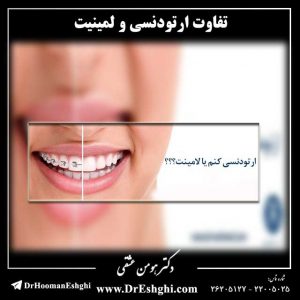 تفاوت ارتودنسی و لمینیت