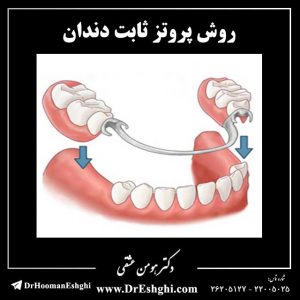 روش پروتز ثابت دندان