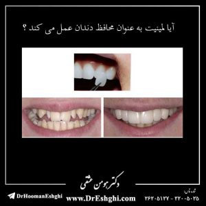 آیا لمینیت به عنوان محافظ دندان عمل می کند ؟