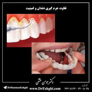 تفاوت جرم گیری دندان و لمینیت