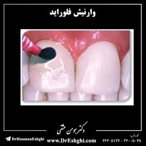 وارنیش فلوراید