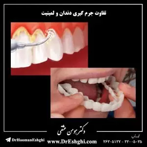 تفاوت جرم گیری دندان و لمینیت