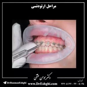 مراحل-ارتودنسی