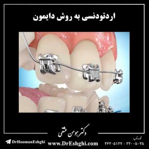 اردتودنسی به روش دایمون