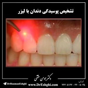 تشخیص پوسیدگی دندان با لیزر