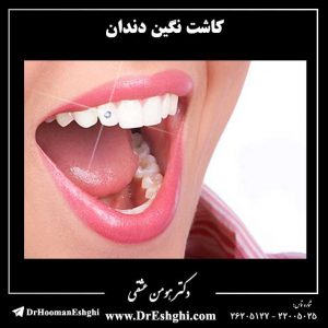 کاشت نگین دندان