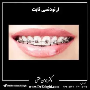 ارتودنسی ثابت