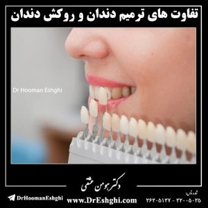 تفاوت های ترمیم دندان و روکش دندان