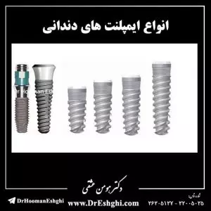 انواع ایمپلنت های دندانی