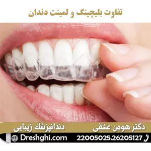 تفاوت بلیچینگ و لمینت دندان