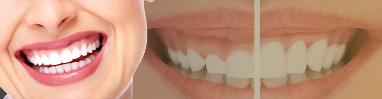 لبخند لثه ای