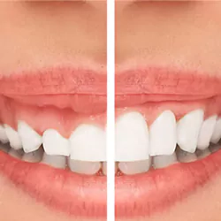 افزایش طول دندان