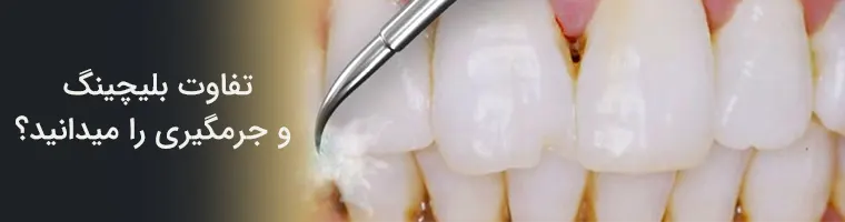 تفاوت بلیچینگ و جرمگیری