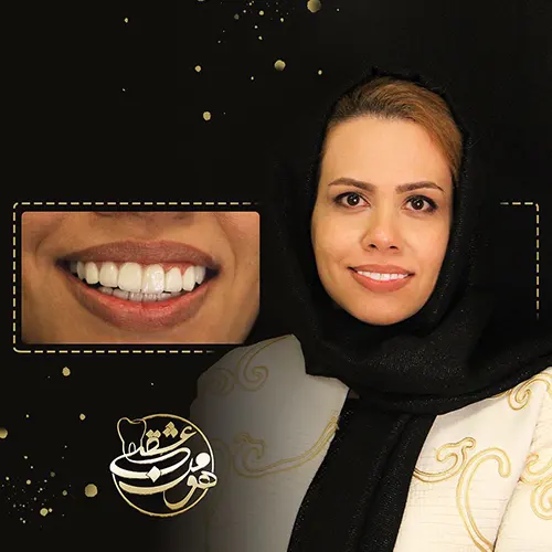 عکس لمینت دندان