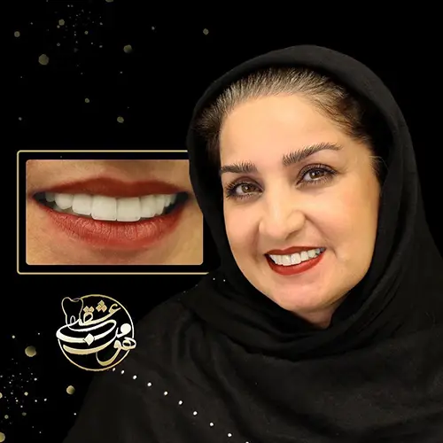 لمینت دندان