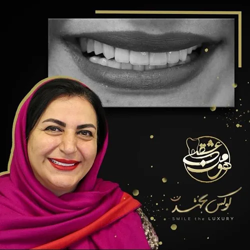 نمونه کار لمینت دندان