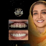 کاندید مناسب لمینت دندان