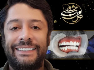 لمینت سرامیکی دندان