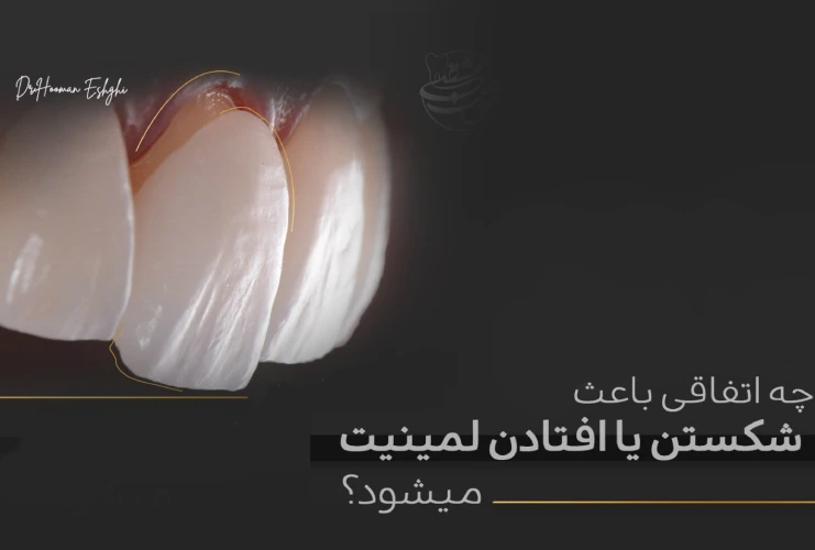 افتادن و شکستن لمینت دندان