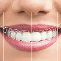 تراز بودن دندان ها