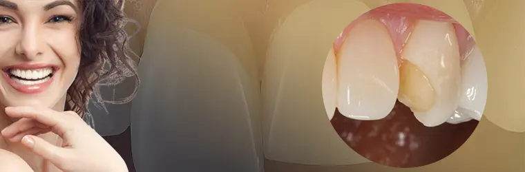 شکستن لمینت دندان