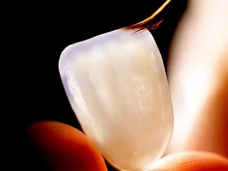 شکستن و افتادن لمینت دندان