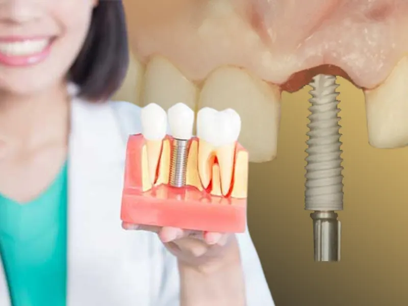 مراقبت های بعد از ایمپلنت دندان