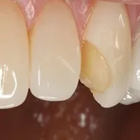 کنده شدن لمینت دندان