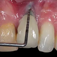 علت پس زدن ایمپلنت