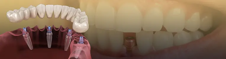 دلایل پس زدن ایمپلنت