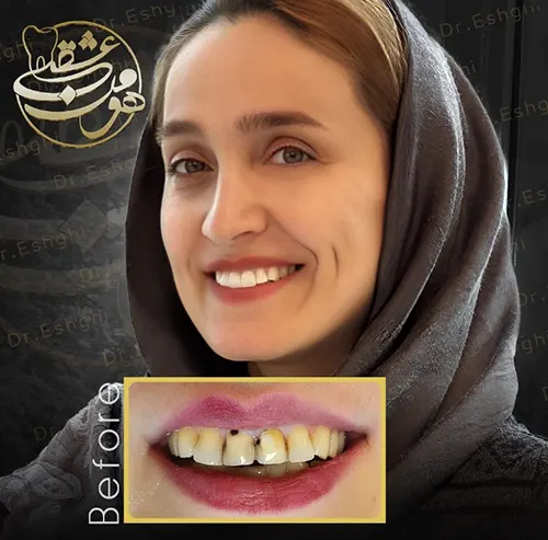 لمینت دندان بدون تراش