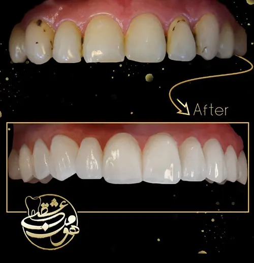 لمینت دندان