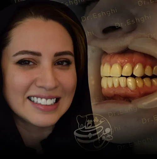 لمینت سرامیکی دندان