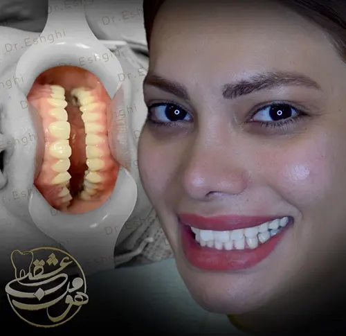 لمینت دندان
