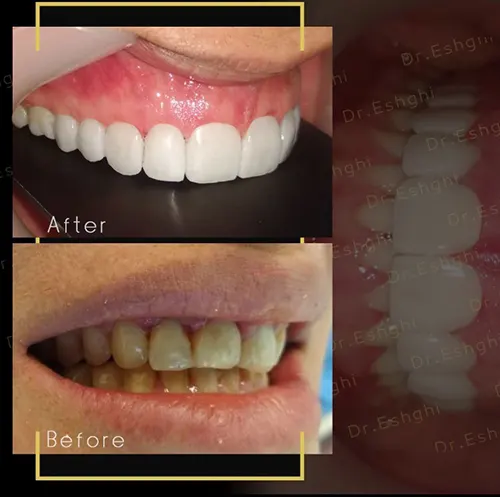 لمینت دندان