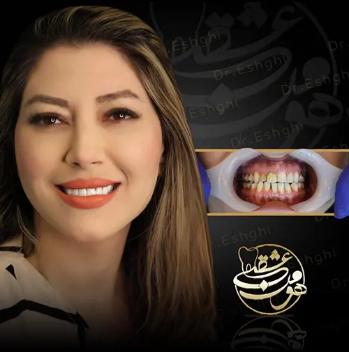 کامپوزیت دندان