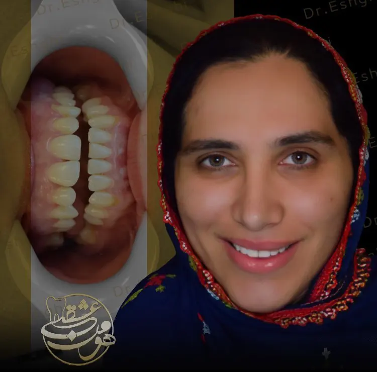 کامپوزیت ونیر