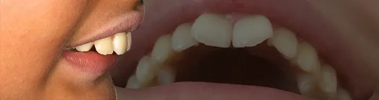 دندان خرگوشی