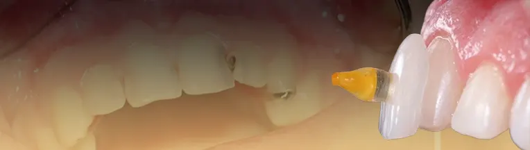 علت پوسیدگی دندان بعد از کامپوزیت