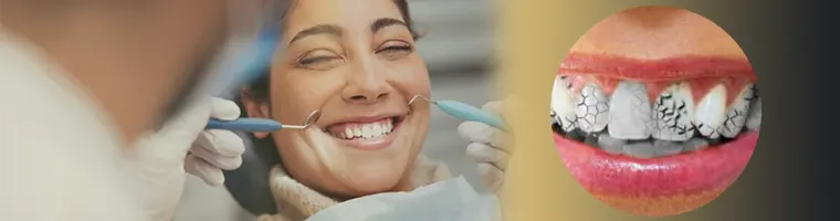 لمینت دندان های عصب کشی شده