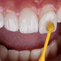 لمینت کردن دندان های خرگوشی