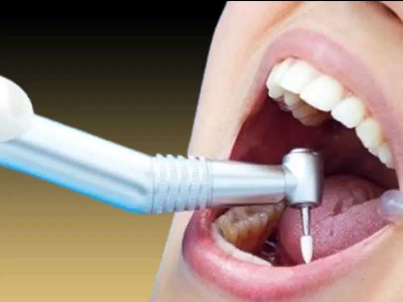 پوسیدگی دندان بعد از کامپوزیت